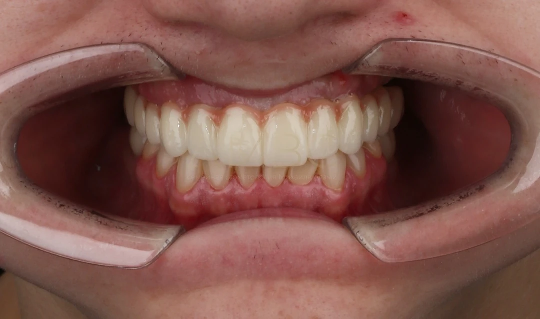 Протезирование зубов