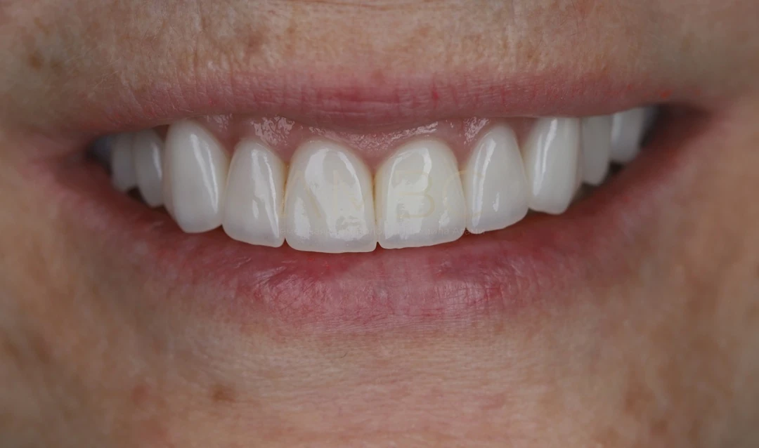 Протезирование зубов