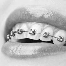 Лингвальные брекеты