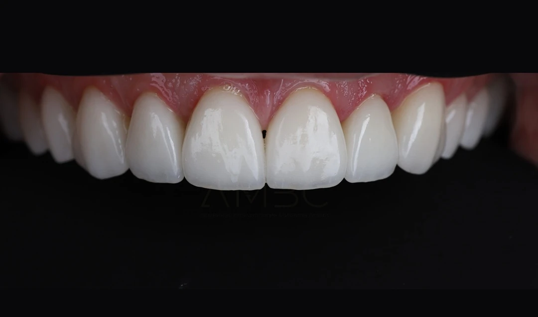 Протезирование зубов