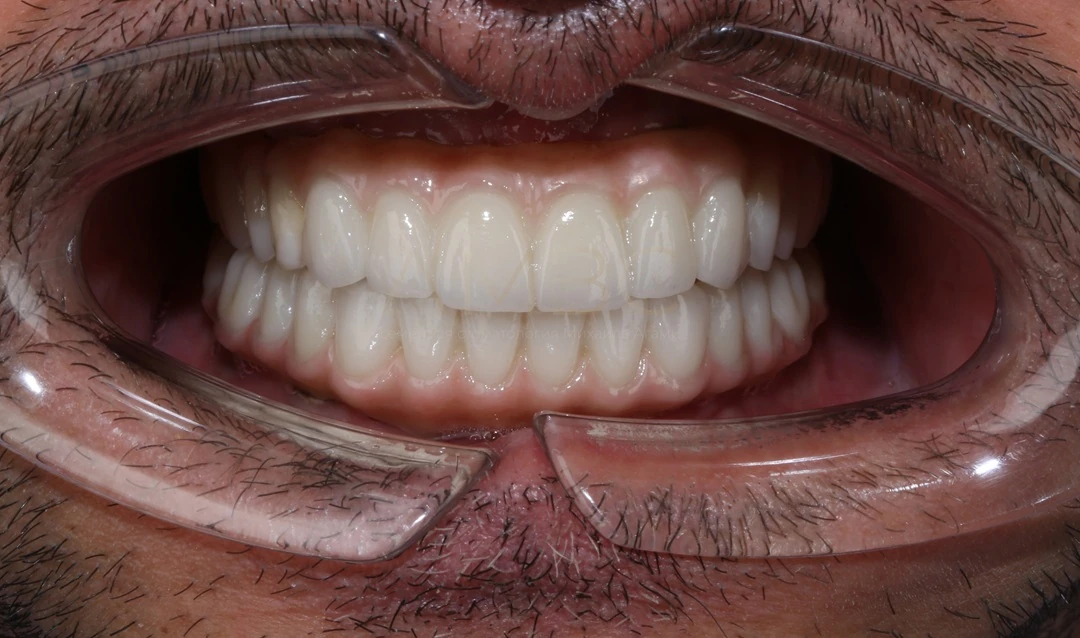 Протезирование зубов