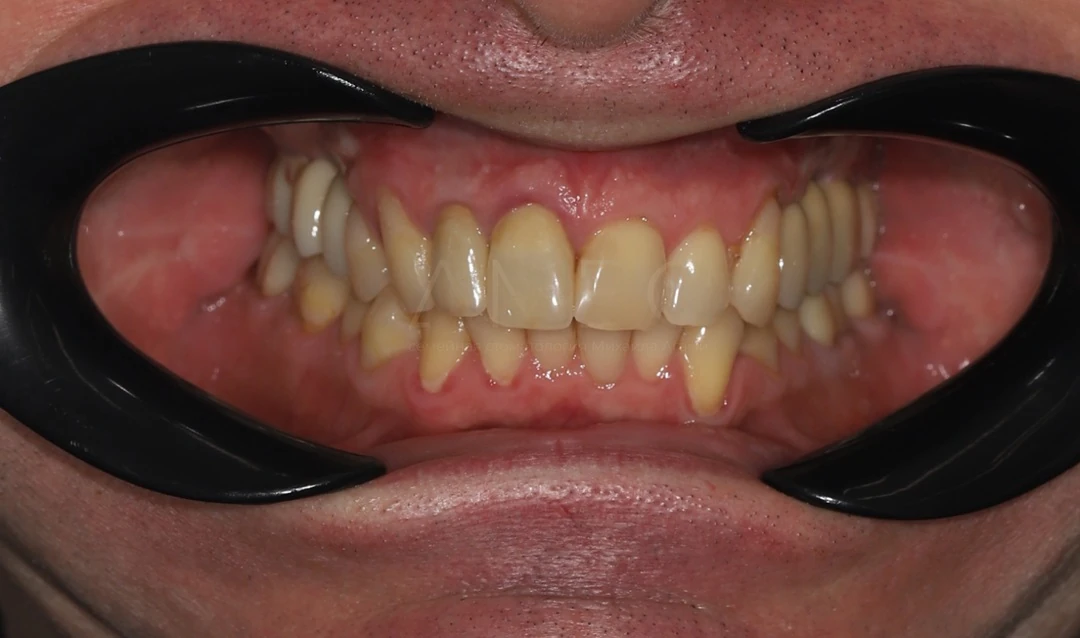 Протезирование зубов