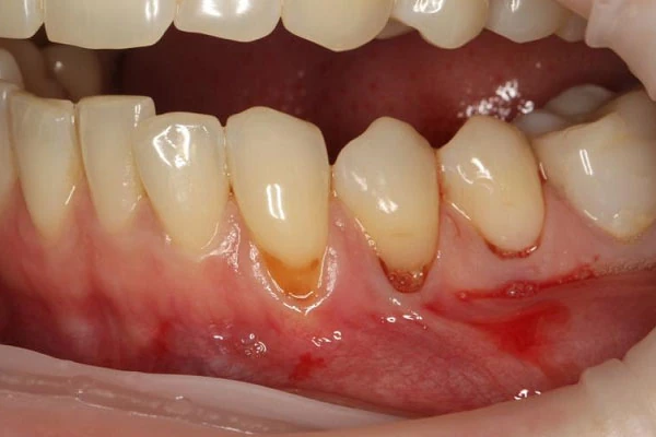 Пластика десны