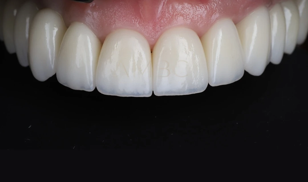 Протезирование зубов