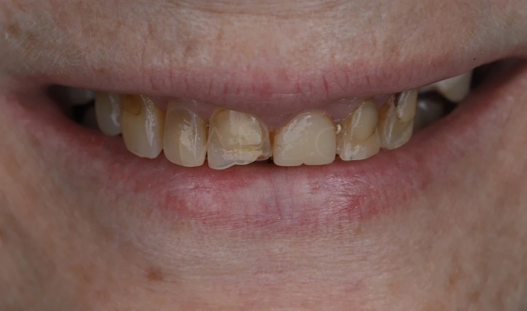 Протезирование зубов