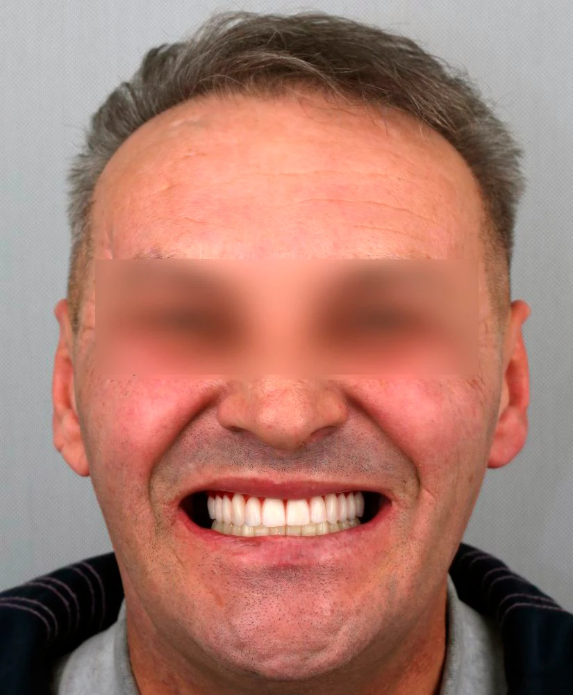 После