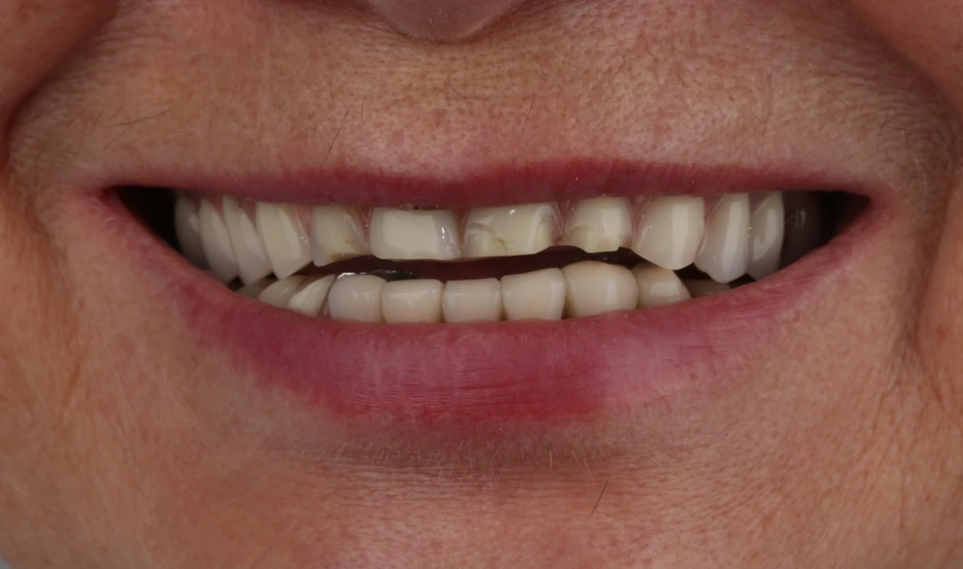 Протезирование зубов