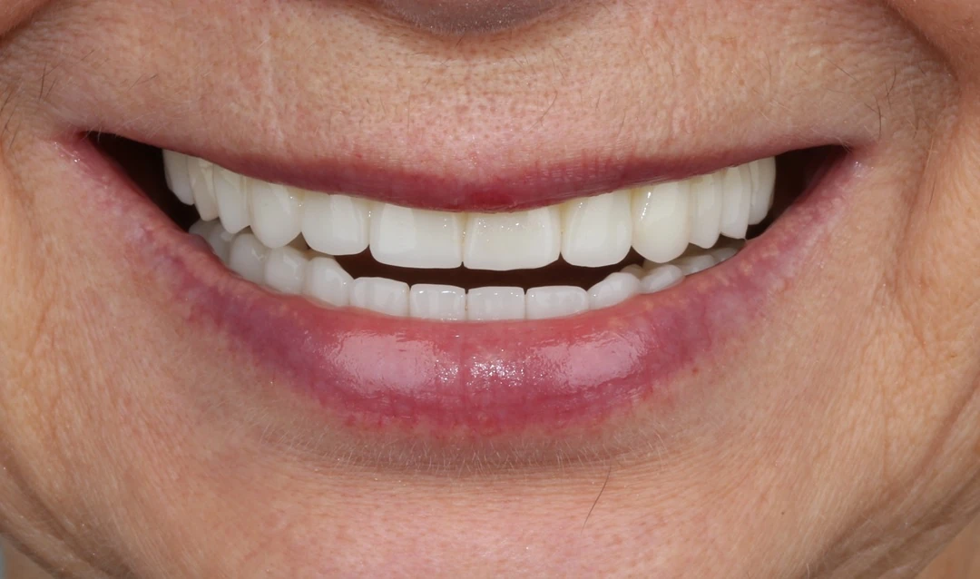 Протезирование зубов