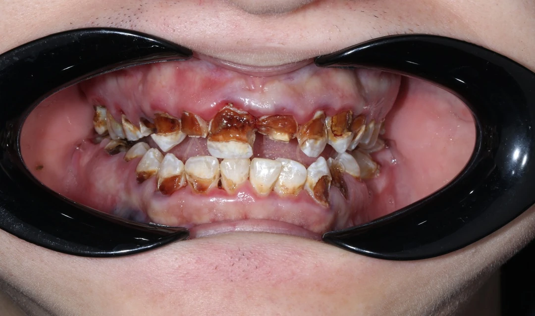 Протезирование зубов