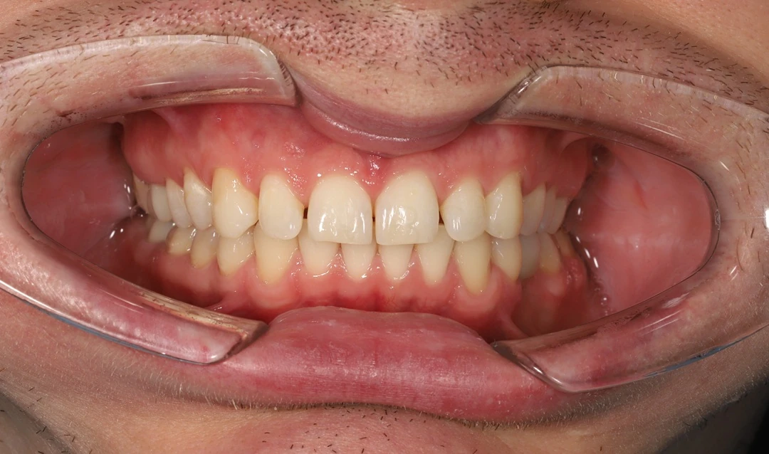 Протезирование зубов