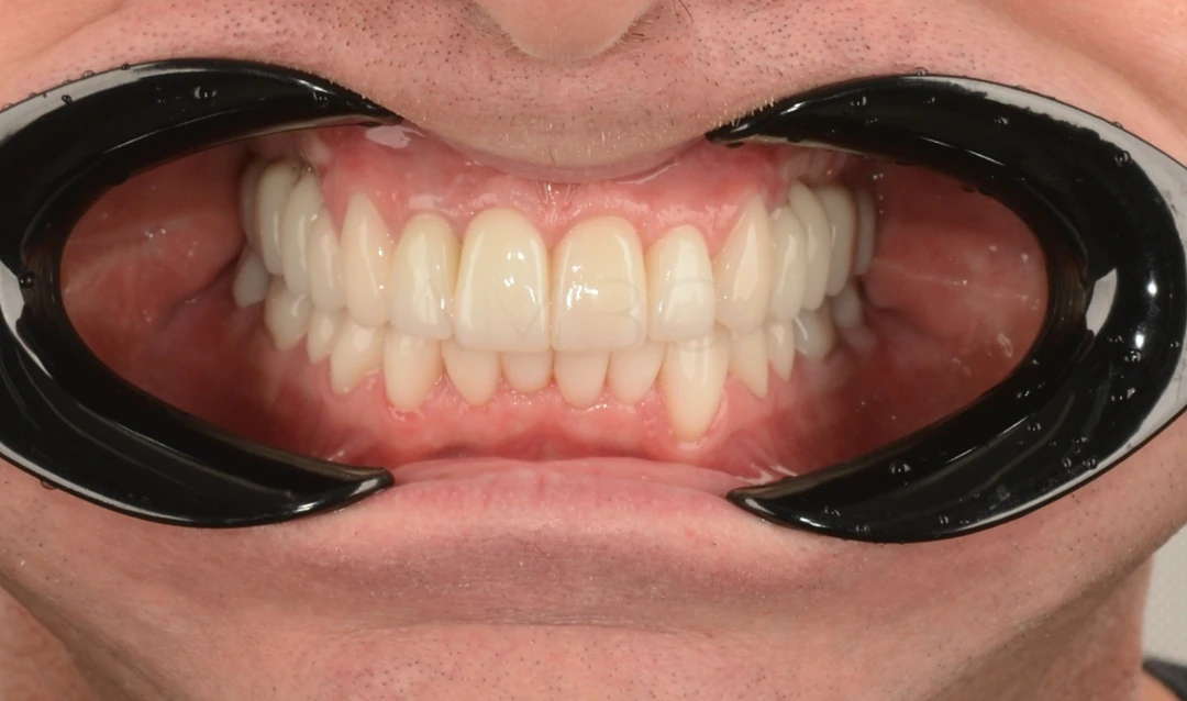 Протезирование зубов