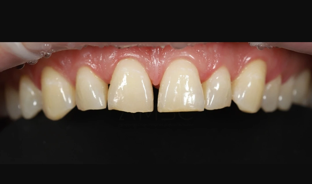 Протезирование зубов