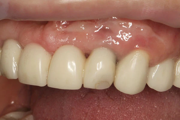 Пластика десны