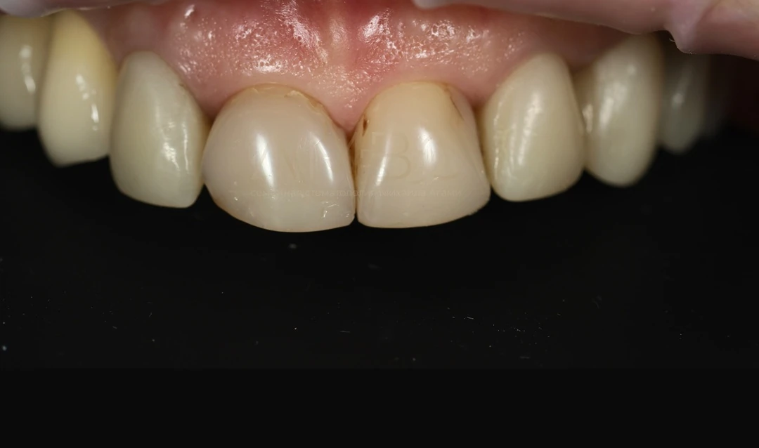 Протезирование зубов