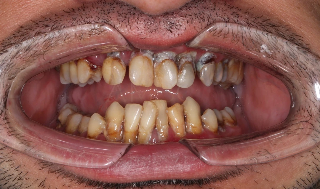 Протезирование зубов