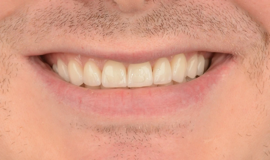 Протезирование зубов