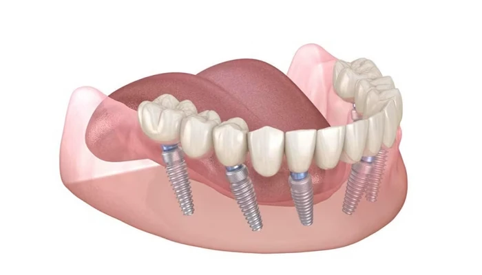 Имплантация All-on-6 за 1 день Имплантация All-on-6 за 1 день