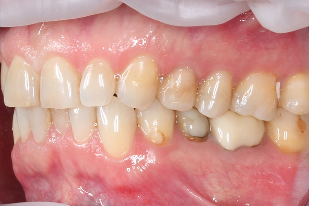 Имплантация и протезирование зубов