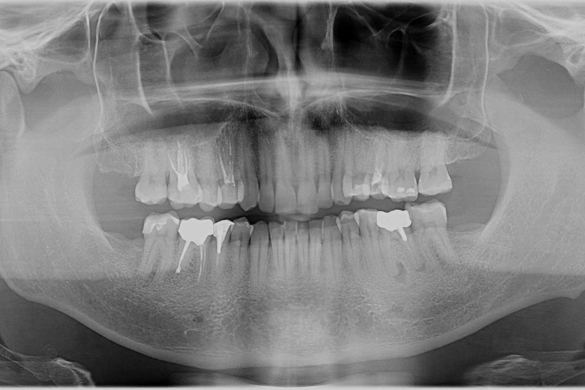 Имплантация и протезирование зубов