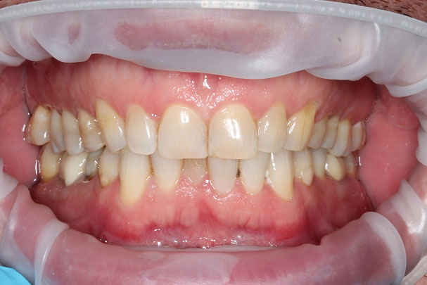 Имплантация и протезирование зубов