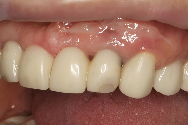 Пластика десны Пластика десны