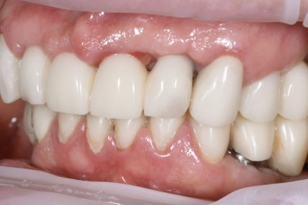 Пластика десны Пластика десны