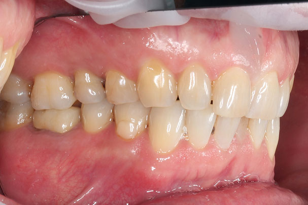 Имплантация и протезирование зубов